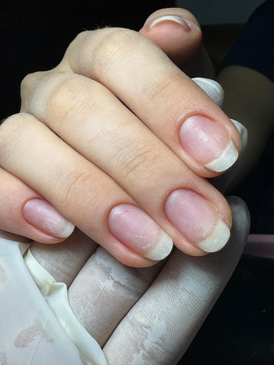 Remoção Técnica de Gel